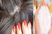 Hé lộ cách trị gàu bằng muối “tiêu diệt” hiệu quả hàng triệu vi khuẩn