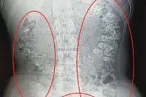 Nghiện trà sữa, bé gái 14 tuổi bị hạt trân châu kẹt đầy bụng