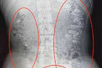 Nghiện trà sữa, bé gái 14 tuổi bị hạt trân châu kẹt đầy bụng