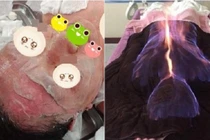 Nguy hiểm rình rập từ hỏa liệu pháp, dùng lửa làm đẹp và chữa bệnh