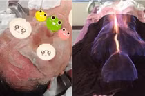 Nguy hiểm rình rập từ hỏa liệu pháp, dùng lửa làm đẹp và chữa bệnh