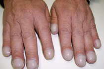 6 dấu hiệu kỳ lạ cảnh báo tim mạch có vấn đề