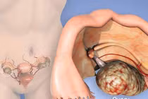 Những kiến thức về ung thư buồng trứng chị em nên biết