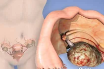 Những kiến thức về ung thư buồng trứng chị em nên biết