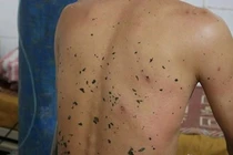 Những trường hợp ong đốt chết người thương tâm