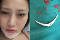 Kinh hoàng biến chứng phẫu thuật thẩm mỹ đáng sợ năm 2018