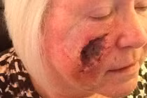 Quý bà thủng lỗ khổng lồ trên mặt do... nghiện tắm nắng