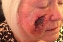 Quý bà thủng lỗ khổng lồ trên mặt do... nghiện tắm nắng