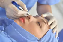 Cắt mí vẫn có thể để lại sẹo nếu chị em không biết những điều sau