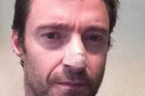 Tài tử điện ảnh Australia mắc ung thư da