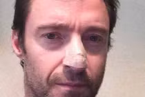 Tài tử điện ảnh Australia mắc ung thư da