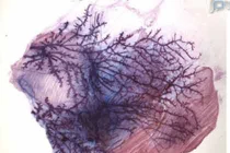 Thử nghiệm tiêm thuốc vào đầu vú để điều trị ung thư