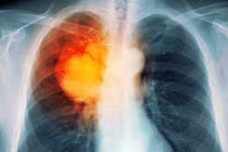 Những điều cần biết về căn bệnh nguy hiểm - ung thư phổi