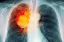 Những điều cần biết về căn bệnh nguy hiểm - ung thư phổi