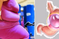Thêm 5 bệnh nhân béo phì tử vong vì bong bóng giảm cân