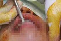 Cô gái phải nạo cằm vì tiêm filler kém chất lượng