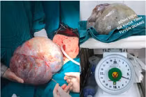 Phẫu thuật thành công khối u buồng trứng khổng lồ nặng 6,2kg