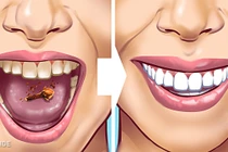 10 cách đơn giản giúp loại bỏ cao răng tại nhà