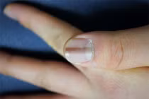 Thấy những dấu hiệu bất thường trên da thế này cần đi khám bác sĩ ngay