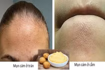 Mụn cám sẽ “không cánh mà bay” nhờ các công thức siêu đơn giản