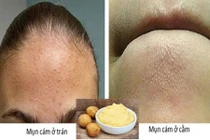 Mụn cám sẽ “không cánh mà bay” nhờ các công thức siêu đơn giản