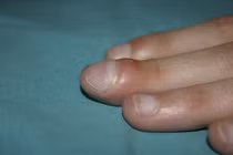 Triệu chứng ở ngón tay cảnh báo ung thư phổi