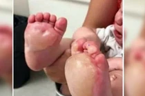 Sự thật rùng rợn về bảo mẫu từ vết phồng rộp trên chân bé 6 tháng tuổi