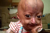 Bé gái 6 tuổi kỳ lạ mang khuôn mặt cụ già