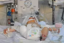 Tháo khớp gối bé sơ sinh văng khỏi bụng mẹ trong vụ tai nạn