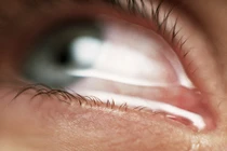 Cảnh giác với những nguyên nhân khiến bạn chảy nước mắt không kiểm soát