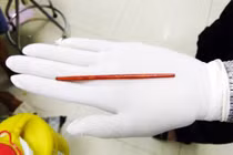 Đồng Nai: Hy hữu chiếc đũa 12cm trong "cậu nhỏ" của nam bệnh nhân