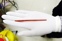 Đồng Nai: Hy hữu chiếc đũa 12cm trong "cậu nhỏ" của nam bệnh nhân