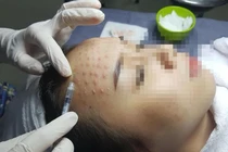 Hiểm họa từ việc tiêm tinh chất DNA cá hồi giúp “cải lão hoàn đồng“