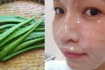 5 cách trị mụn bọc tại nhà, mụn to đến đâu cũng xẹp lép sau 1 đêm