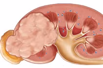 Bỏ ngay 5 thói quen này nếu không muốn chết sớm vì ung thư thận