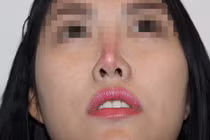 Kinh hoàng biến chứng nâng mũi: Lòi sụn, hoại tử lõm mũi