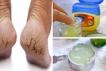 3 cách dùng vaseline trị nứt gót chân không phải ai cũng biết