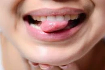 Triệu chứng ung thư lưỡi thường bị bỏ qua vì nhiều người từng mắc