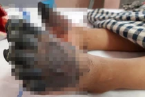 Bé gái 3 tuổi phải cắt bỏ tứ chi vì vết phồng ở tay chân