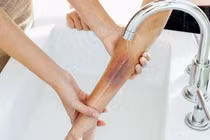 Bé ngã vào chảo dầu sôi, hành động của cha mẹ hóa ra hại con