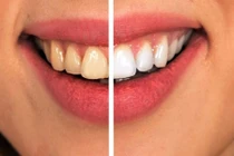 8 cách đơn giản ngừa sâu răng không cần dùng thuốc