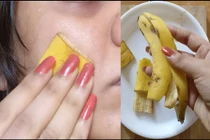 Dùng vỏ chuối trị các loại mụn trên da không tốn một xu