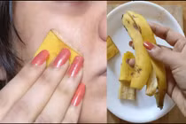 Dùng vỏ chuối trị các loại mụn trên da không tốn một xu