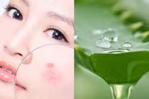 Lấy lại làn da mịn màng với cách trị mụn cóc chỉ tốn 2000 đồng