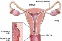 Cách ngừa ung thư cổ tử cung bằng tiêm chủng