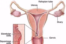 Cách ngừa ung thư cổ tử cung bằng tiêm chủng