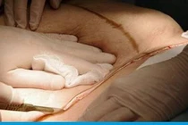 Rầm rộ trào lưu kết hợp bóc mỡ giảm béo khi mổ đẻ, thực hư tác dụng?