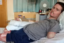 Người đàn ông phải cắt bỏ chân tay và một phần gương mặt để giữ mạng sống