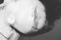 Xót xa những trường hợp trẻ nhỏ bị chó cắn tổn thương nghiêm trọng