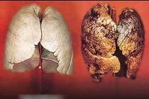 Điểm mặt những bộ phận cơ thể dễ bị ung thư nhất